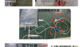膀胱冲洗操作视频,步骤与技巧全解析